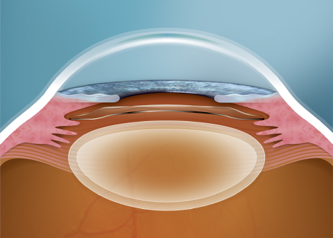 眼内コンタクトレンズ治療ってどんな治療法？